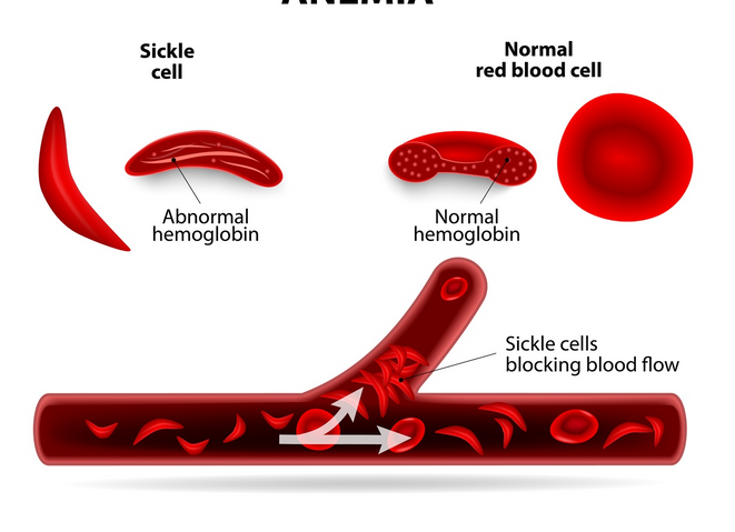 Diagram of sickle cells blocking blood flow through vessels causing pain 'crisis https://www.bing.com/images/search?view=detailV2&ccid=4EKzs%2fXV&id=E1940660A2FA1D65EA89579E2384D3D3293F6033&thid=OIP.4EKzs_XVz0FYa8UwzMdV0QHaFo&mediaurl=https%3a%2f%2fhealthjade.com%2fwp-content%2fuploads%2f2017%2f09%2fsickle-cell-anemia.jpg&exph=1142&expw=1500&q=Sickle+Cell+Anemia&simid=608017093041720586&ck=35C5AD8C25C7AB0CF36B675005FD1B41&selectedIndex=7&FORM=IRPRST&ajaxhist=0
