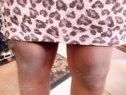 Phostina - Zambia - Knee Swelling of the Left and Right Knee, predominantly the Right hand side